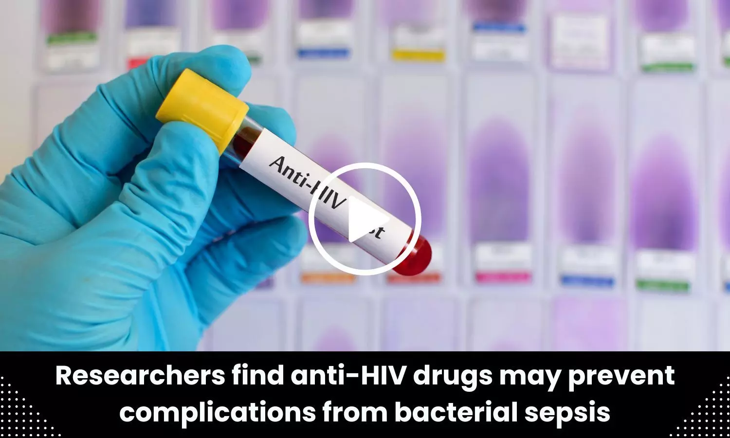 Anti-HIV drugs may prevent complications from bacterial sepsis says study