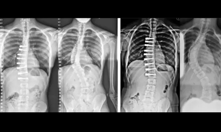 Machine learning-based tool may help plan new treatment in patients with adolescent idiopathic scoliosis