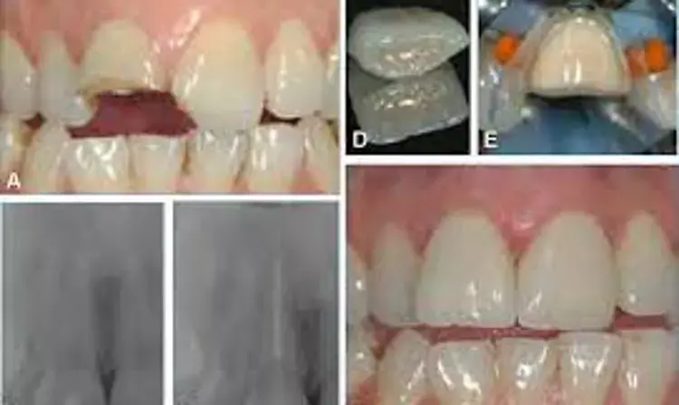What are the risk factors for  retention of endodontically treated teeth?