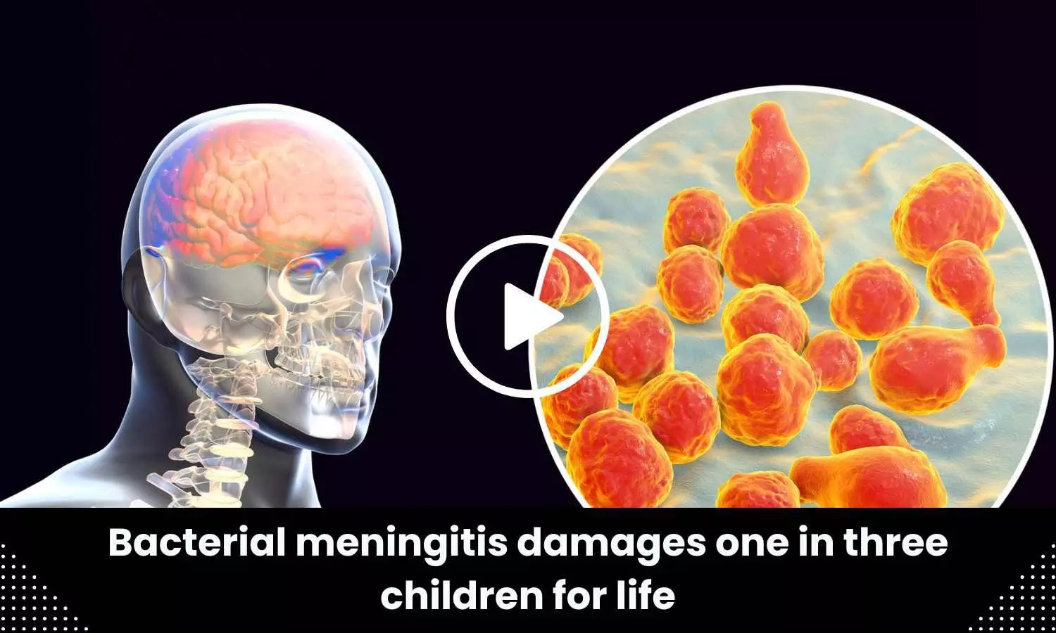 Bacterial meningitis damages one in three children for life