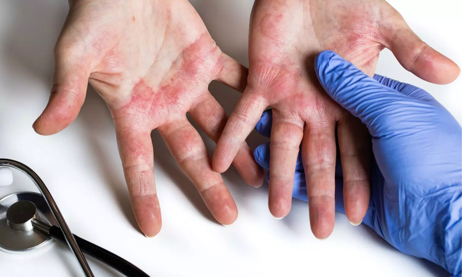 Study Explores Unreported Allergic Contact Dermatitis due to Salicylic Acid