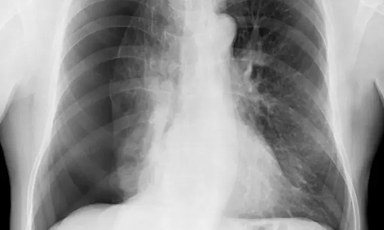 Intraoperative partial spray of 50% glucose effectively prevents recurrence and complications in pneumothorax