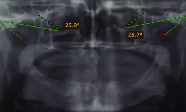 CBCT and digital axiography promising methods for sagittal condylar guidance angle assessment