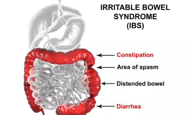 Ebastine may provide subjective relief among patients with non-constipated IBS