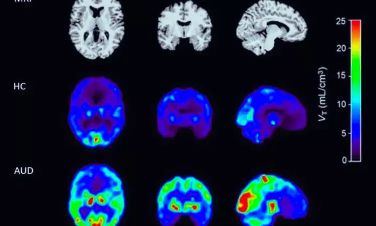 PET scans reveal key molecular driver of stress and addiction in people with alcohol use disorder