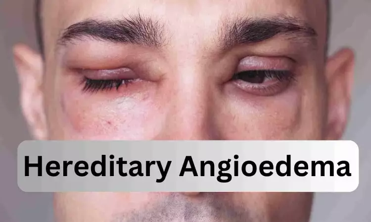 Donidalorsen reduces rate of angioedema attacks in patients with hereditary angioedema in phase 3 trial
