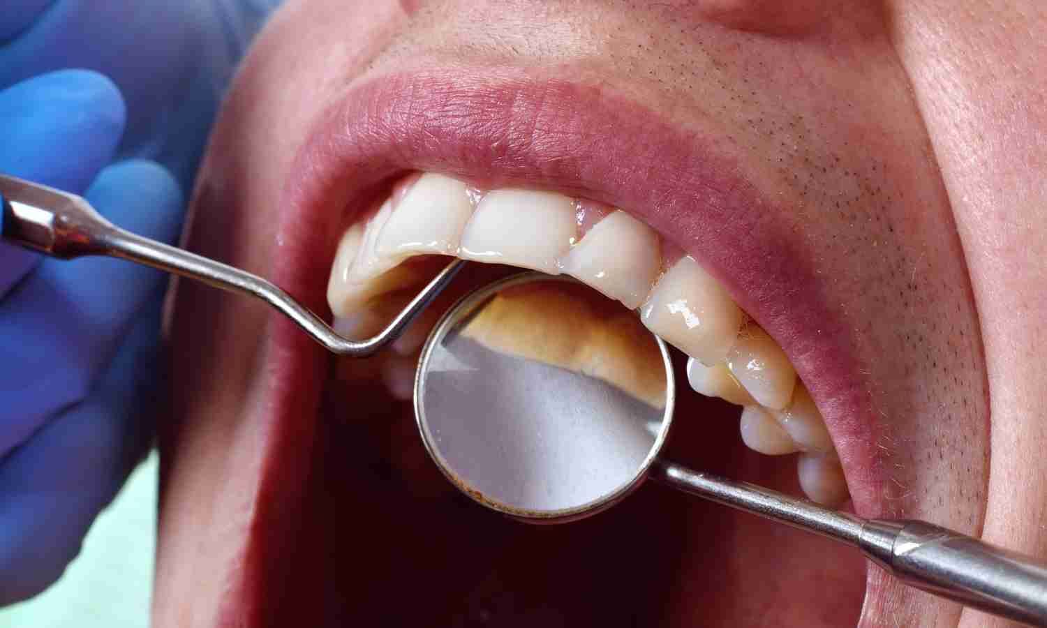 Regular Oral Care Improves Outcomes in hepatic decompensation and compensated Cirrhosis: Study