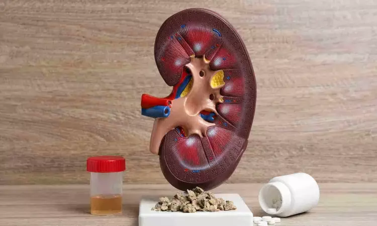 Pushing kidney-stone fragments reduces stones recurrence, suggests study TAKE-HOME