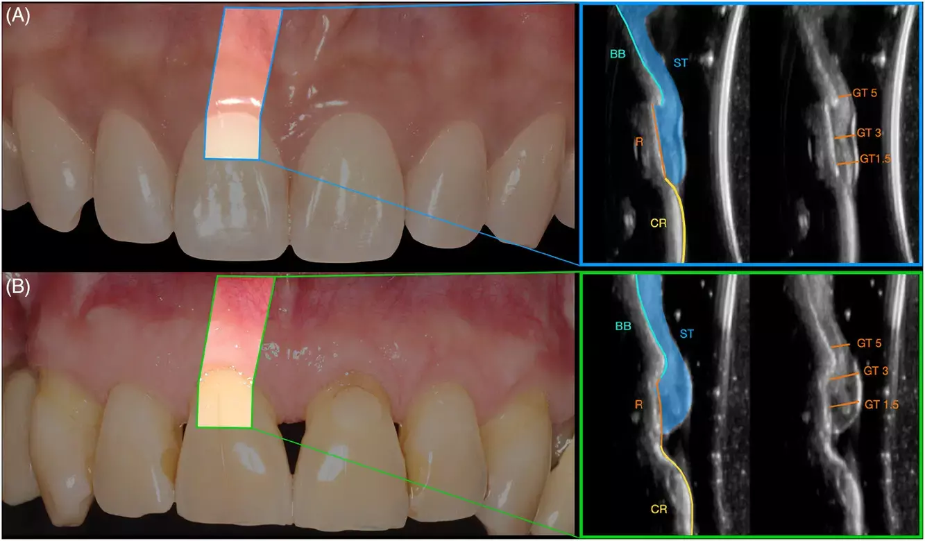 Cone-beam CT images may help identify several risk indicators of midfacial gingival recession in esthetic region