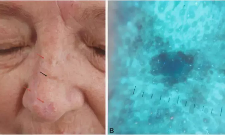 Ultraviolet-induced fluorescence dermoscopy improves precision in non-neoplastic dermatoses