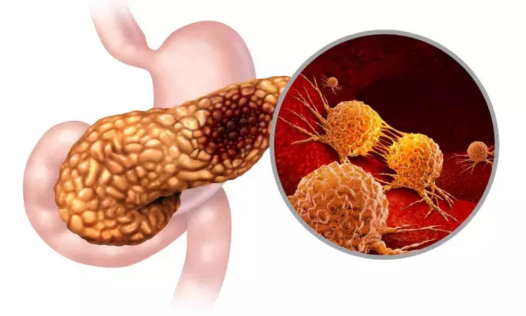 A new protein linked to metastasis in pancreatic cancer say researchers