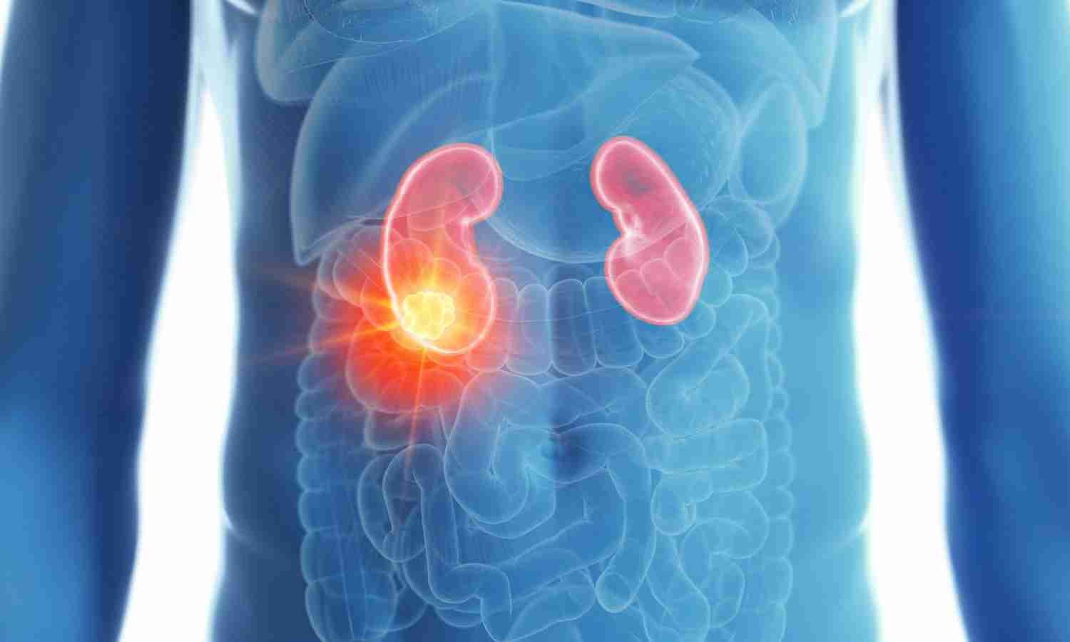 Ablation Shows Comparable Outcomes With Fewer Complications in T1a RCC: Study