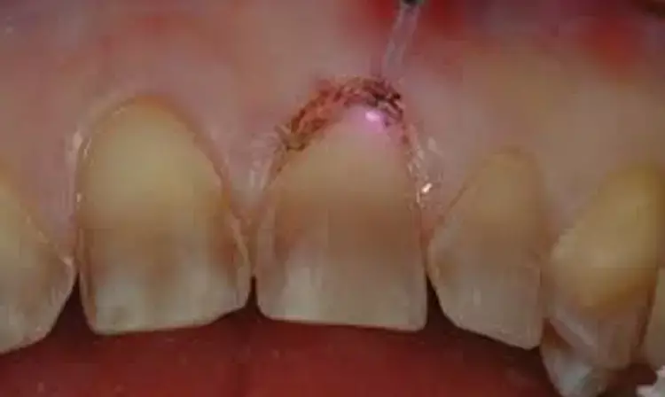 Dental lasers tied to better Gingival displacement and bleeding control during gingival troughing