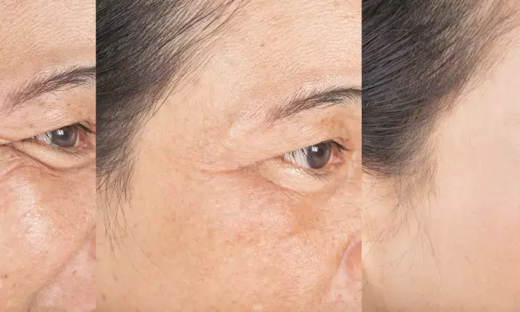 Same-day combo of chemical peels and neurotoxins safe and effective cosmetic therapy for photoaging