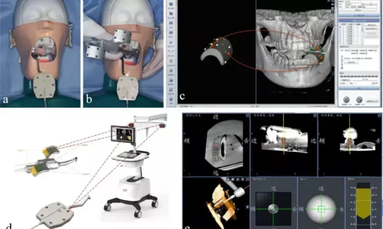 Robot navigation clinically reliable method for implant placement