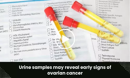 Urine samples may reveal early signs of ovarian cancer