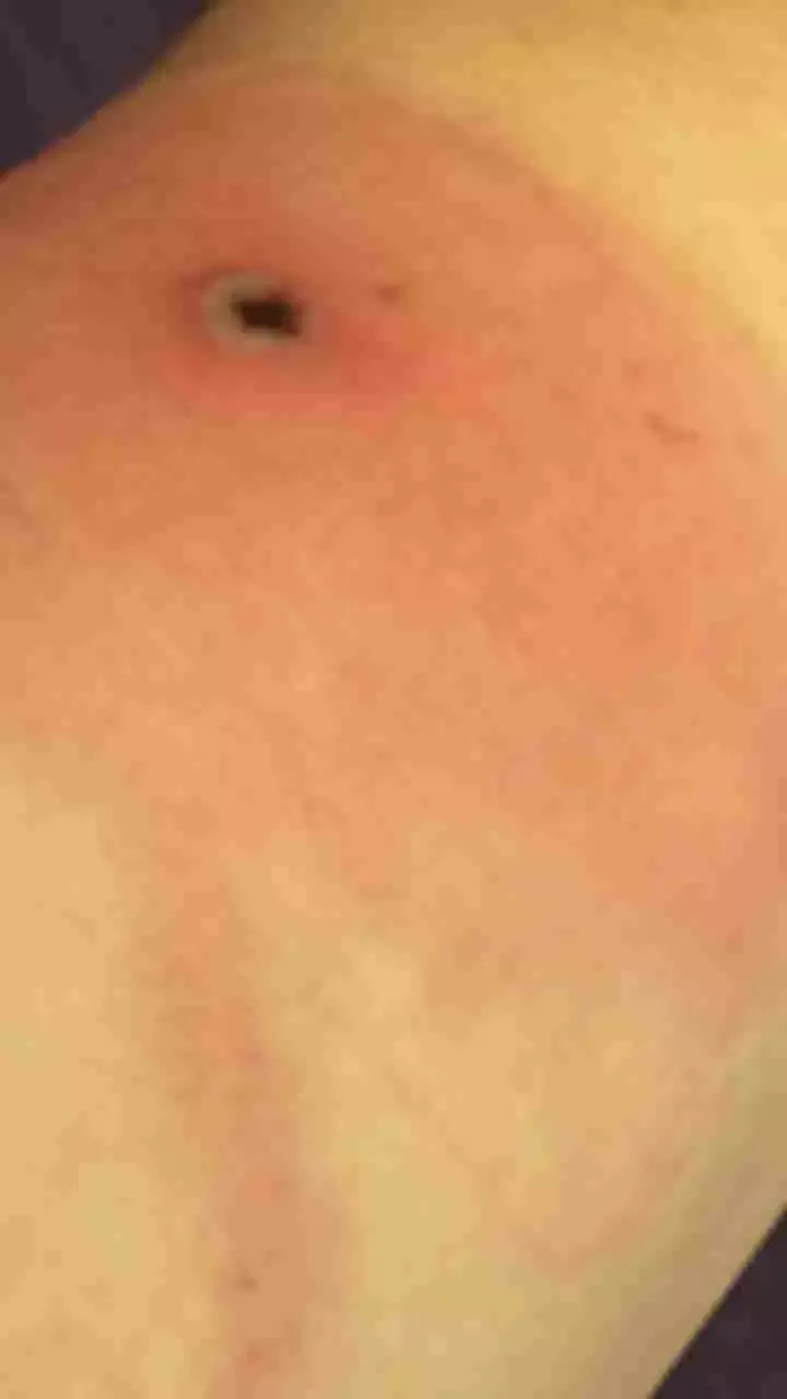 What Is Alaskapox?  Symptoms, Signs, And Details About Virus Transmission To Humans