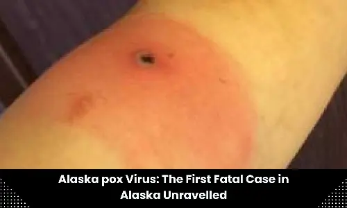 Alaskapox: First fatal case in Alaska unravelled