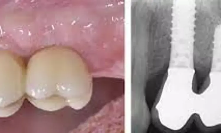 Shorter dental implants viable option to longer dental implants among patients with Limited Ridge Height in Posterior Maxilla