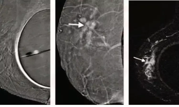 Study suggests contrast-enhanced mammography as an alternative to breast MRI for imaging lobular carcinoma