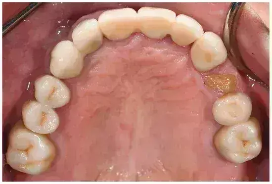 Zirconia-based single-tooth restorations are reliable alternative materials to metal-based restorations with favourable outcomes