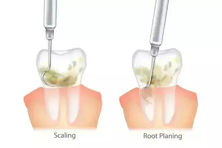 Scaling and root planing tied to reduced bleeding vs GBM among patients under periodontal maintenance: Study