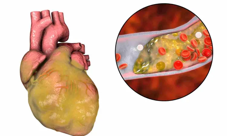 Photon-counting CT improves coronary artery disease assessment, reveals study