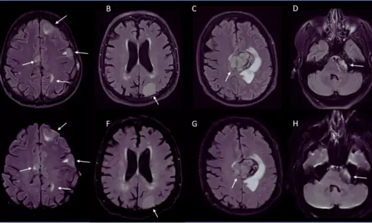 Deep learning-accelerated MRI improves detection of acute ischemic stroke: Study