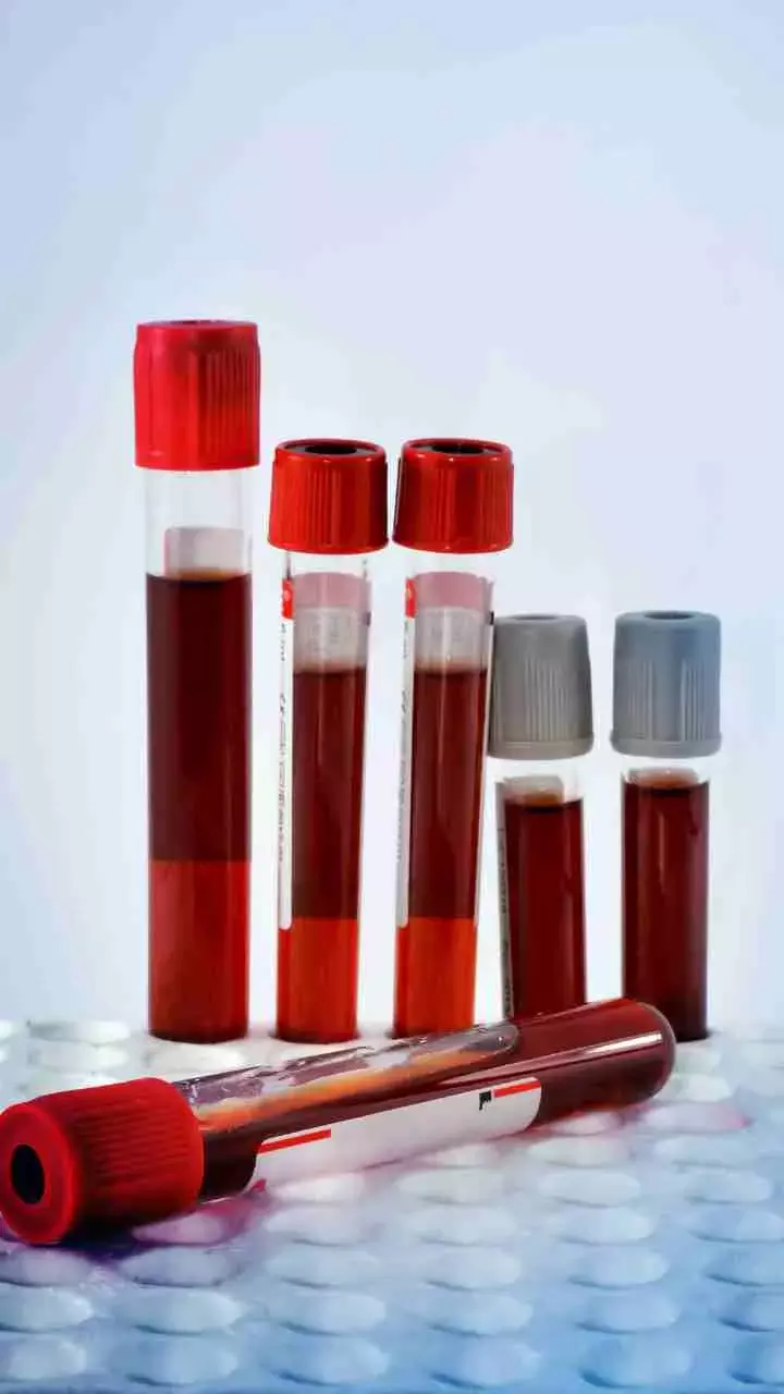 Maharashtra Grapples with Rising Sickle Cell Anemia Cases, Know More About It