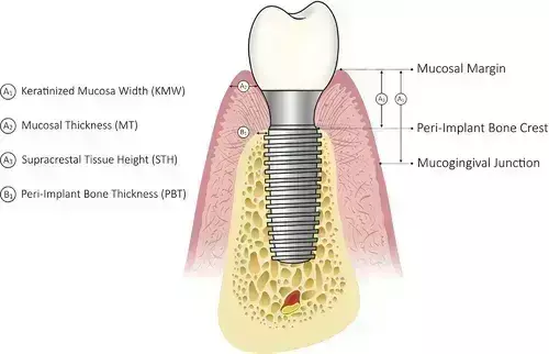 Keratinized mucosal width, supracrestal tissue height and dental implant diameter may influence peri-implant marginal bone loss
