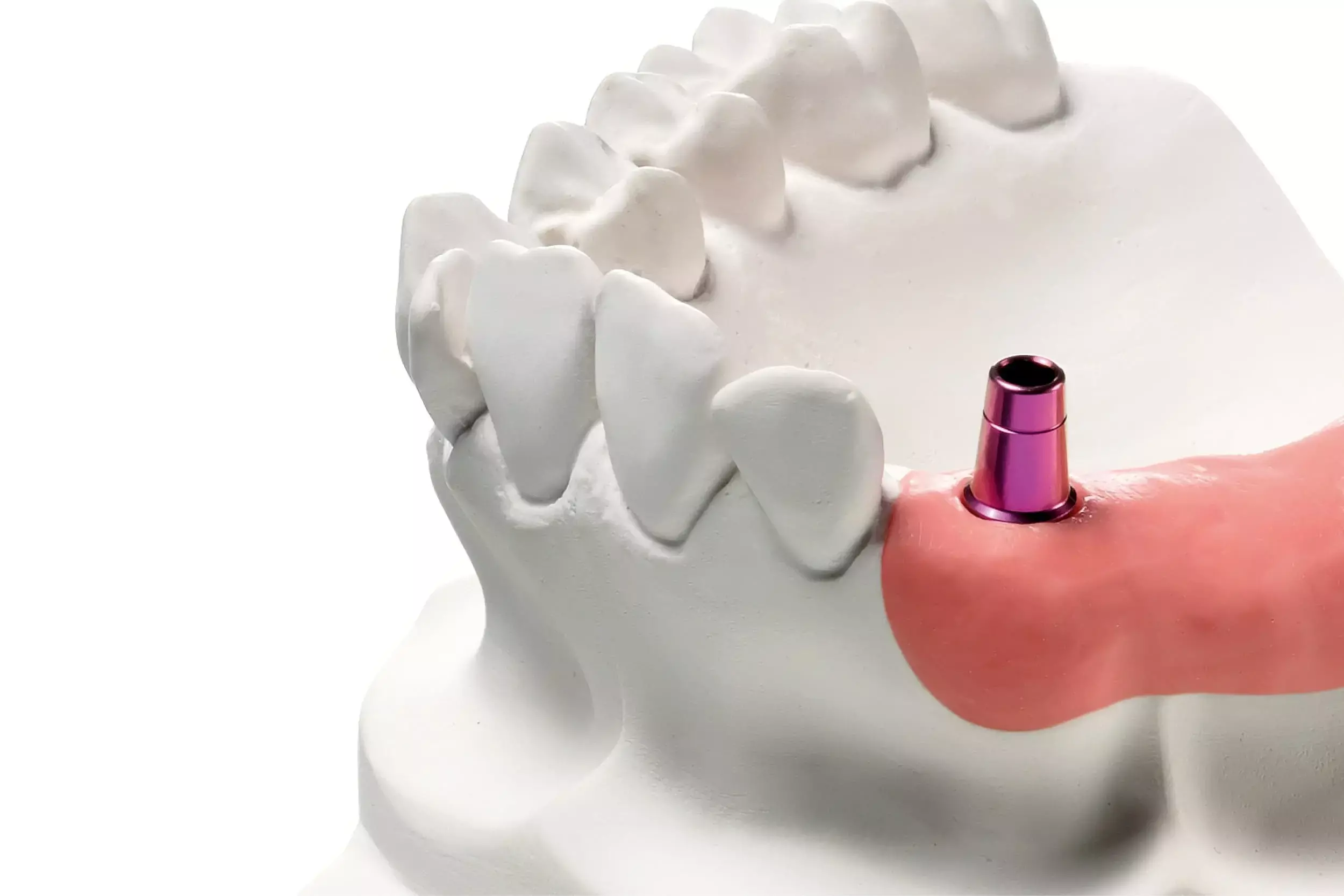 CAPS system may streamline fabrication process of implant supported fixed complete dental prostheses in one single visit: Study