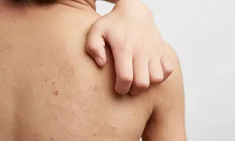Children with atopic dermatitis experience hindered growth compared to peers: PEDISTAD trial