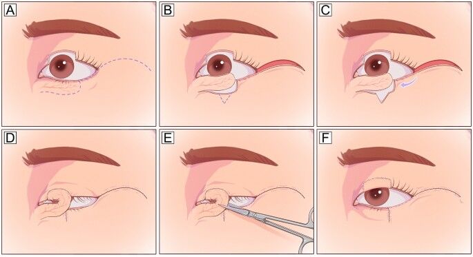 Hatchet flap versatile, effective, and safe technique for eyelid and