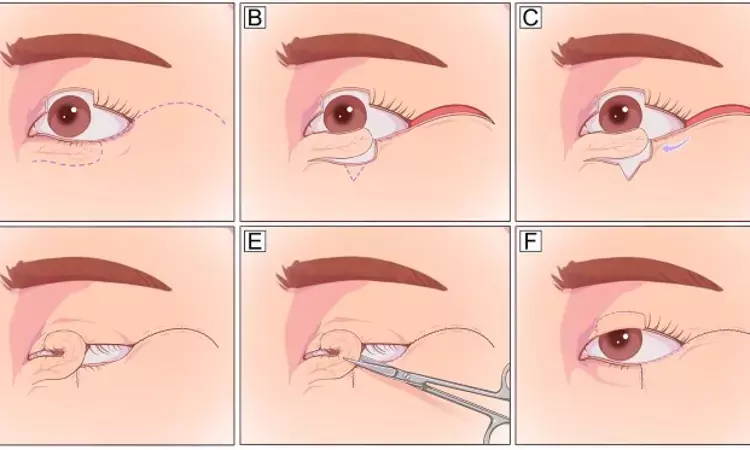 Hatchet flap versatile, effective, and safe technique for eyelid and midfacial reconstructions in select patients: Study