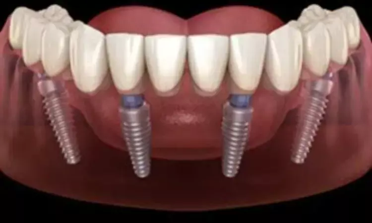 Full-mouth rehabilitation with dental implants viable option for patients with cognitive and physical disabilities: Study