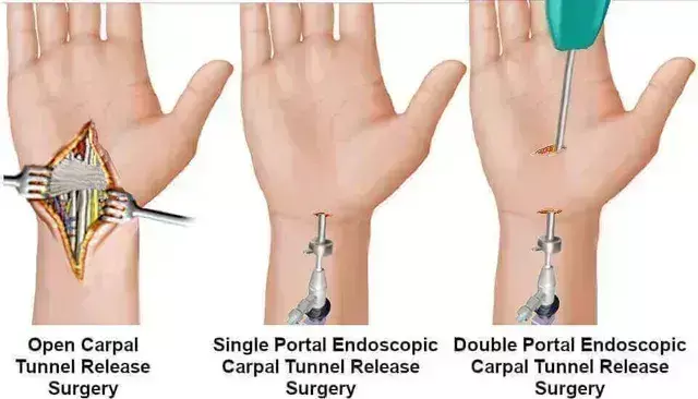 Endoscopic Carpal Tunnel Release associated with increased risk of revision when compared with Open procedure: JAMA