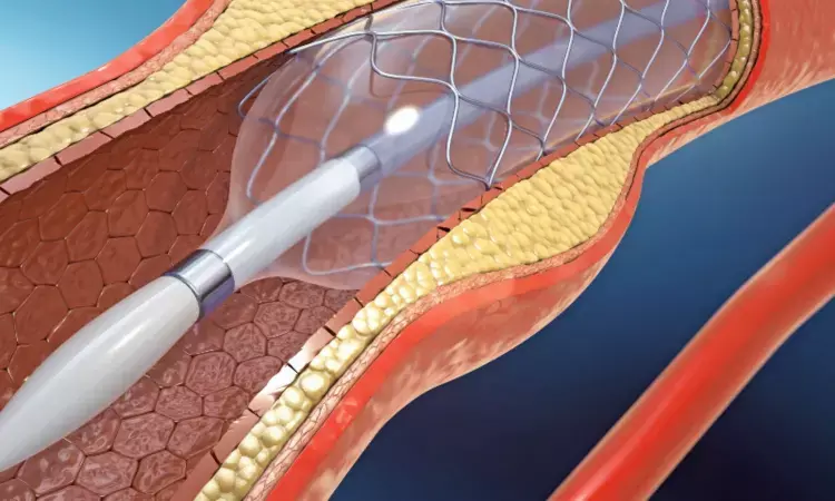 Paclitaxel-coated balloon effective for managing coronary in-stent restenosis among patients undergoing PCI: JAMA