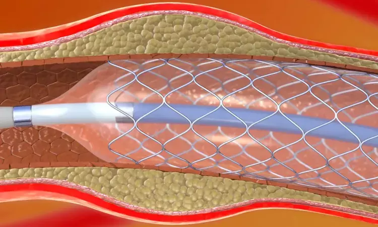 Incremental rise in glycated hemoglobin in diabetics associated with Stent failure after PCI: Study