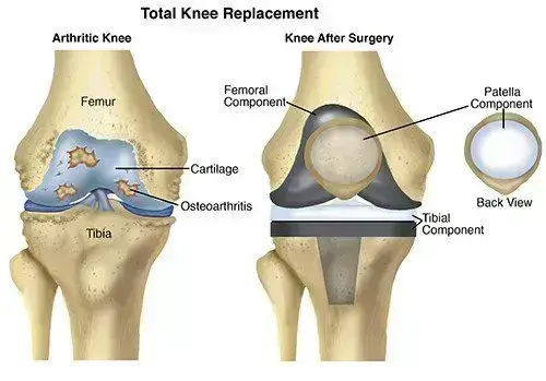 Case of total knee arthroplasty for knee osteoarthritis associated with abnormal patellar tendon deformity: a report