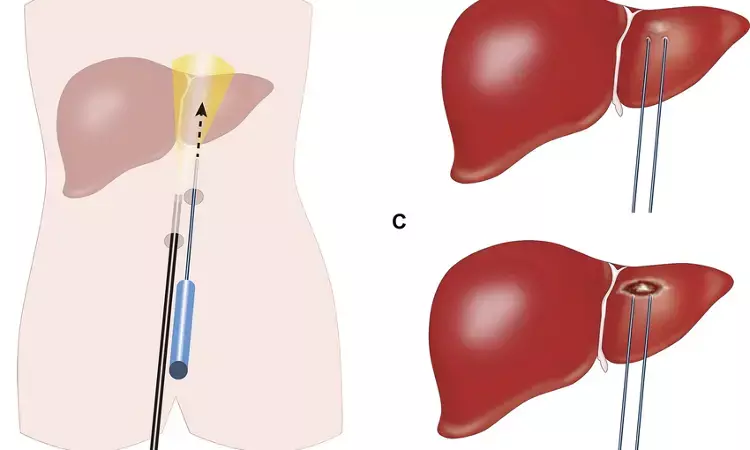 Laparoscopic hepatectomy as effective as percutaneous radiofrequency ablation for treating small hepatocellular carcinoma: Study
