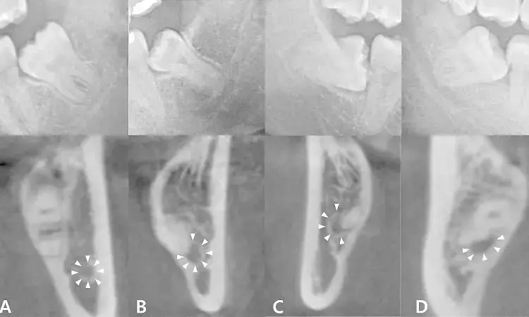 AI-powered 3D models based on CBCT may predict injury risk to Inferior alveolar nerve after third molar extraction: Study