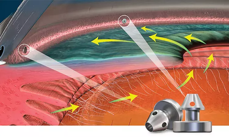 Cataract surgery  and iStent Inject combo tied to significantly greater reduction of IOP in mild glaucoma patients: Study