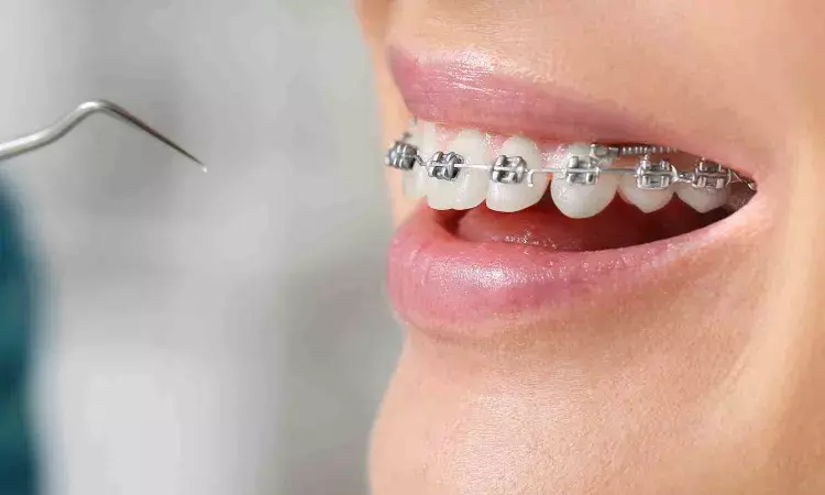 New AI tool may help correctly fit braces onto teeth: Study
