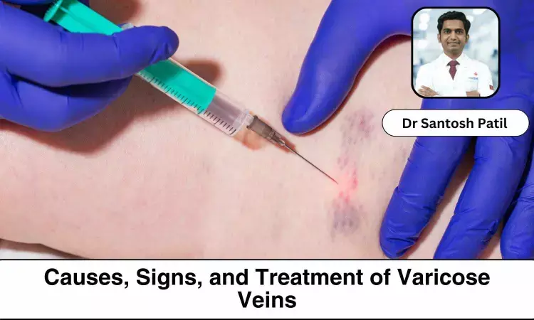 Understanding Varicose Veins: Signs, Causes, and Treatment - Dr Santosh Patil