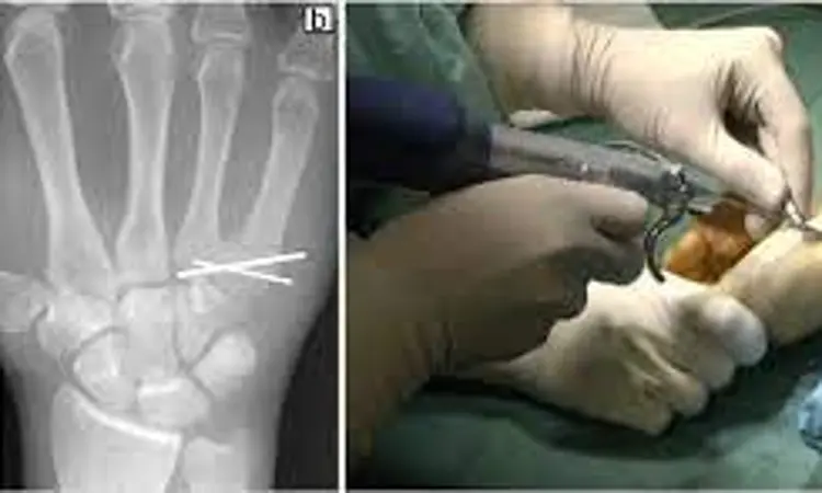 U-shaped Kirschner wire internal fixation safe and effective treatment  for Skiers thumb: Study