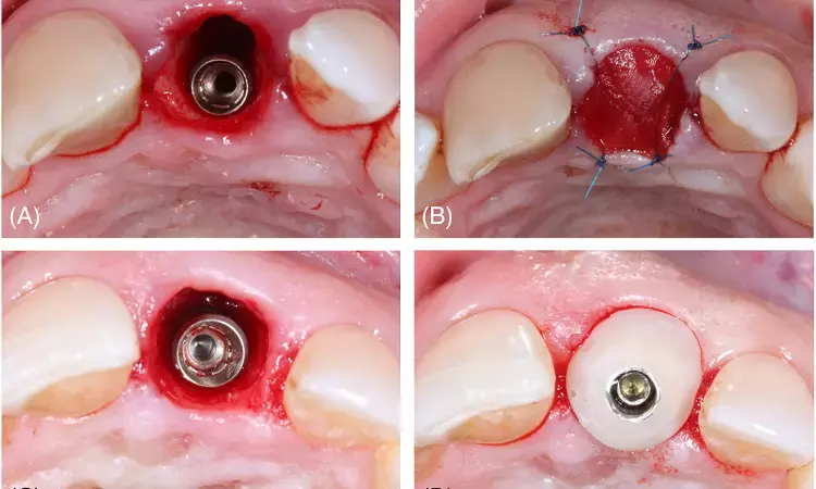 Customized Healing Abutments for Immediately Placed Implants tied to Favorable Peri-Implant Soft Tissue Outcomes: Study
