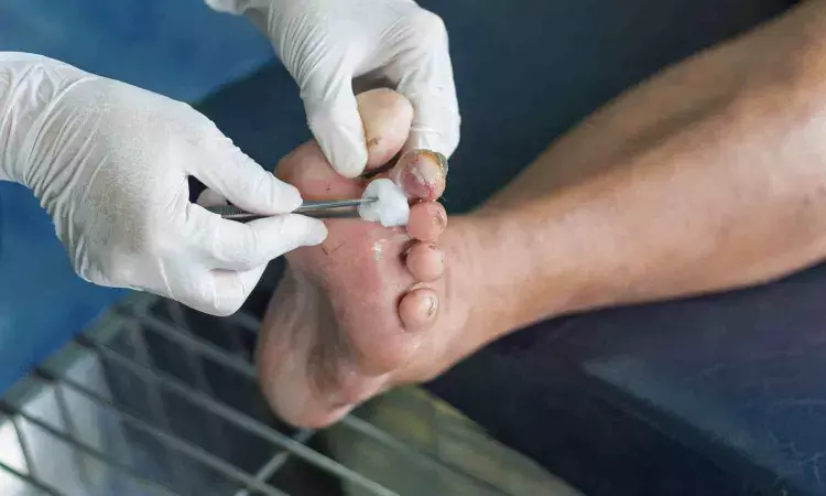 Use of microneedles may promote diabetic wounds healing, suggests study