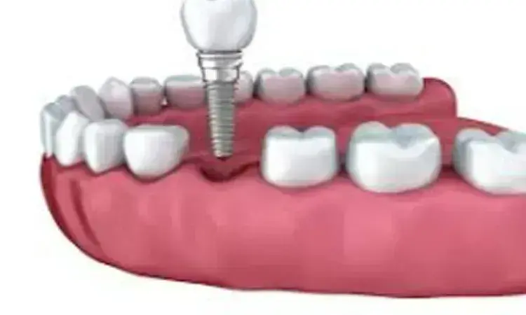 Survival rate of Metal-ceramic and monolithic zirconia implants 100% after 5 years, reveals study