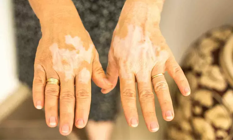 Oral Tofacitinib arrests vitiligo progression and induces repigmentation when combined with phototherapy: Study