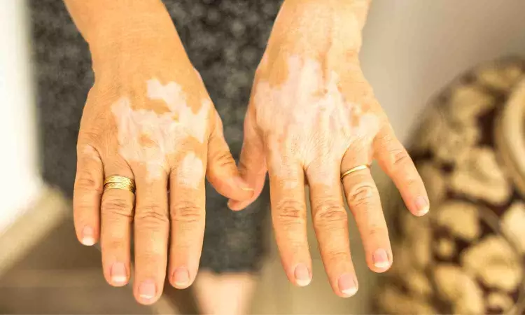 Both targeted and whole-body NB-UVB are effective treatment options for acral vitiligo patients: Study